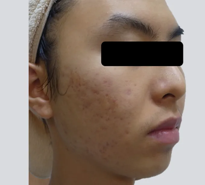 李承鴻皮膚科煥膚治療後
