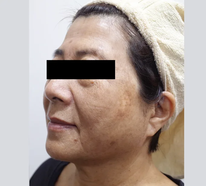 李承鴻皮膚科診所M22彩衝光治療後