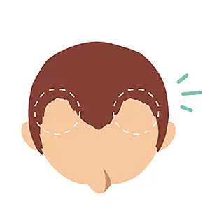 髮際線後退