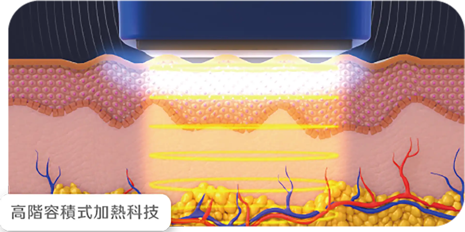 十倍電波，促進膠原蛋白增生。