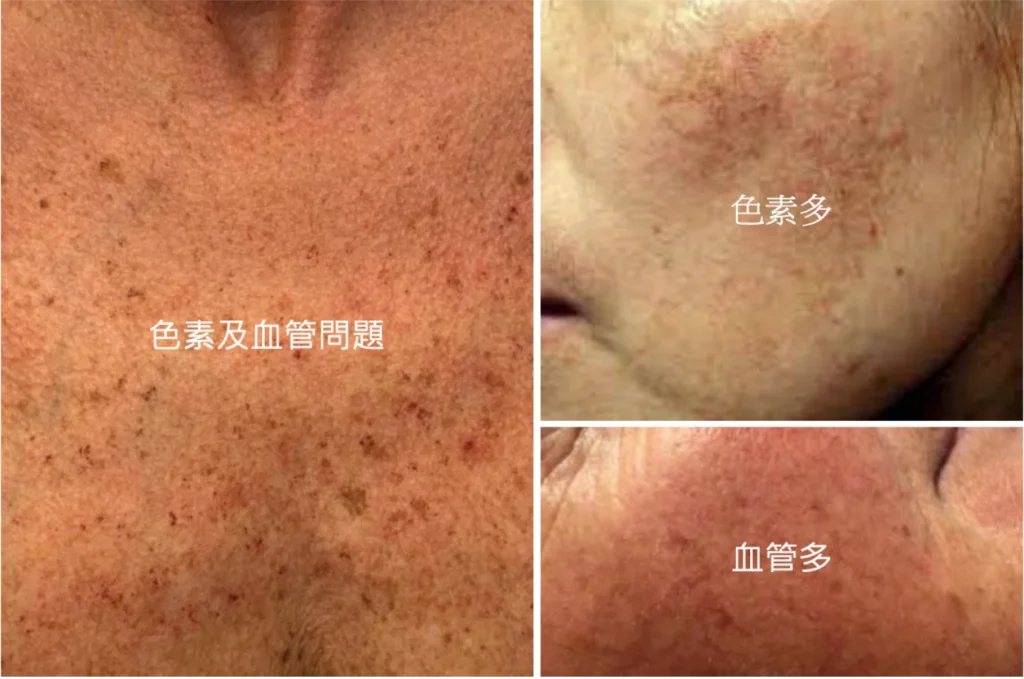 色素問題