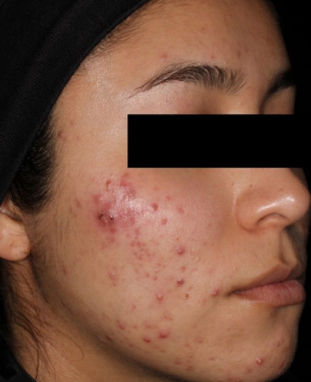 Img-AviClear -Before-02